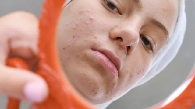 Atok pomáhá s porblematickou pletí