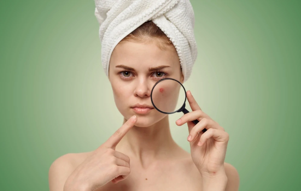 ATOK Pečující krém při akné Viana 100ml